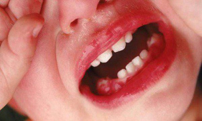 Bài thuốc chữa viêm lợi, hôi miệng